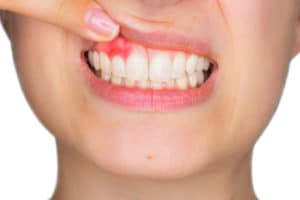 Beispiel einer Zahnfleischentzündung